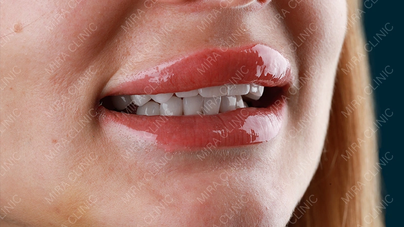 The look is the Hollywood Smile